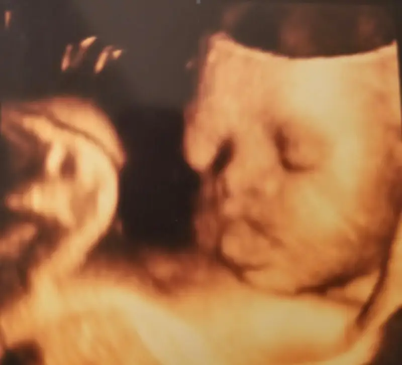 A 3D ultrasound of Noah before he was born